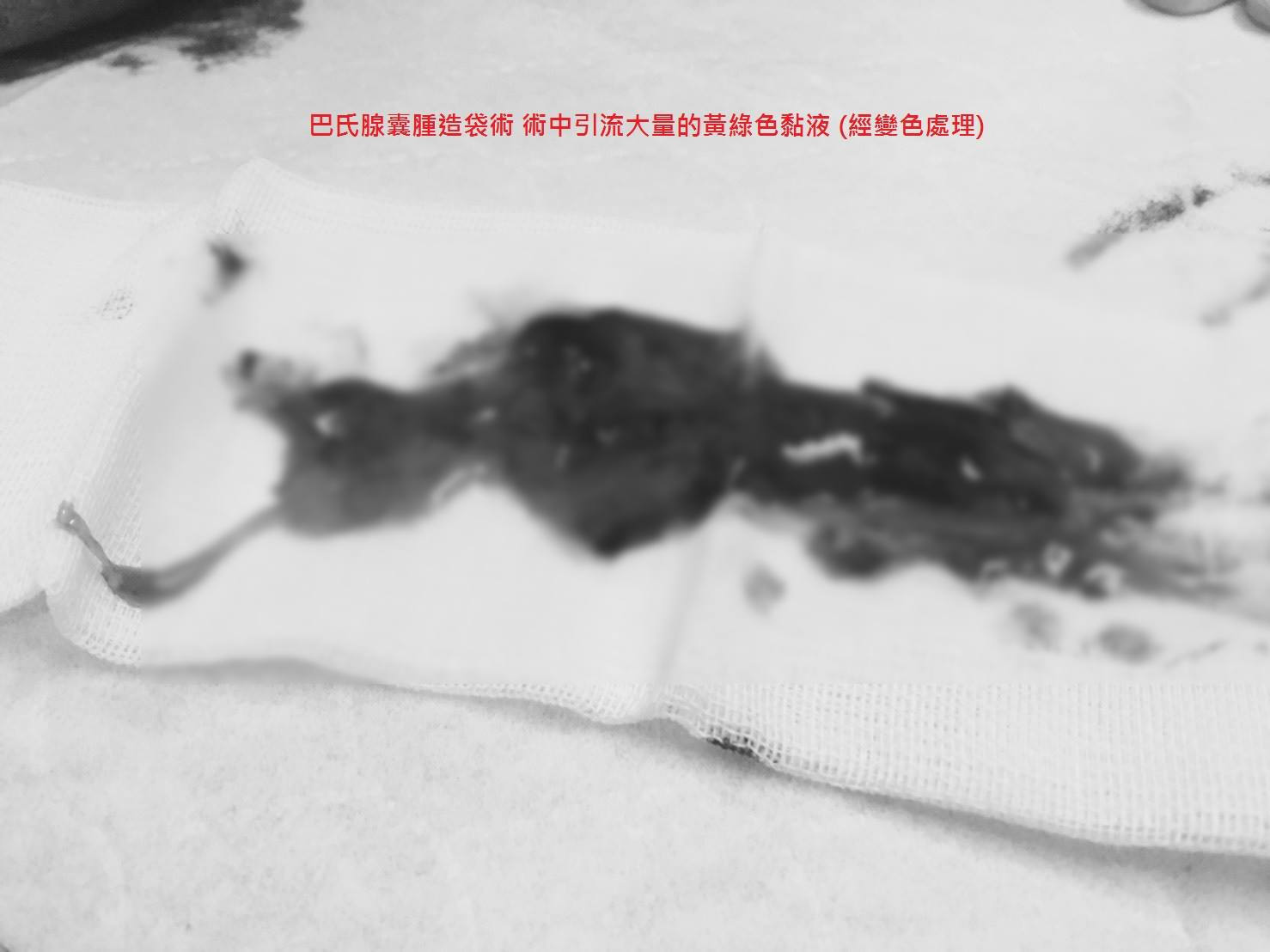 變色處理的術後黏液照片