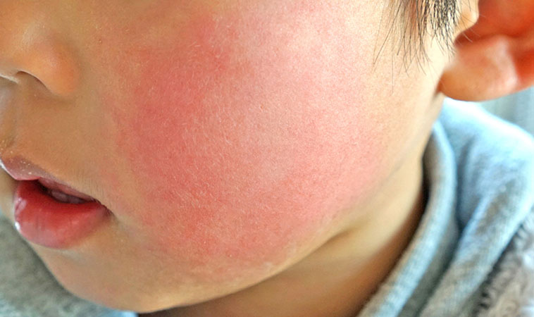 台中11歲女童買完包子，大叫一聲昏迷突離世，不是流感，體內疑驗出B19微小病毒陽性