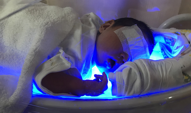 寶包黃疸怎麼辦？爸媽看過來，認識新生兒黃疸三類型