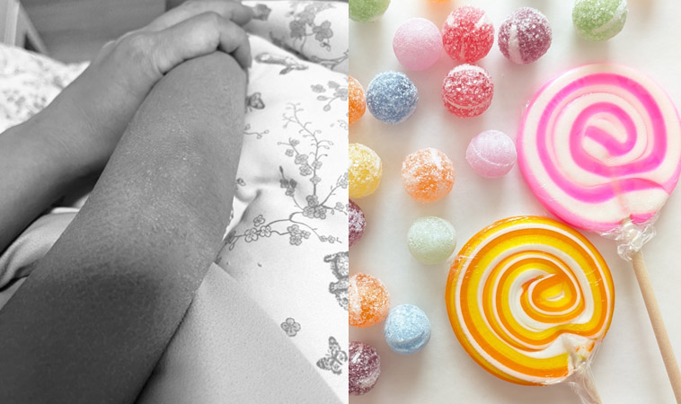 一點糖也可能引發皮膚大過敏，能不能吃糖請問過照顧者，不是所有的愛都要靠零食表達！