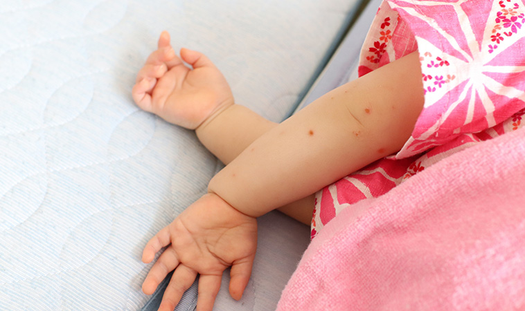 2026腸病毒首例奪命警報！南部女童發病7天不治，醫揭「這型」沒水泡最難防！