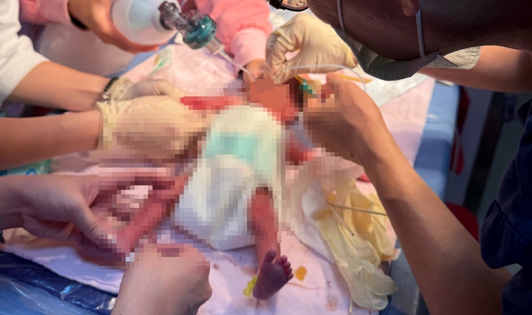 孕婦兩次早產，第三胎28週劇烈腹痛又提早落紅，寶寶出生僅1320克，醫：用時間搶命