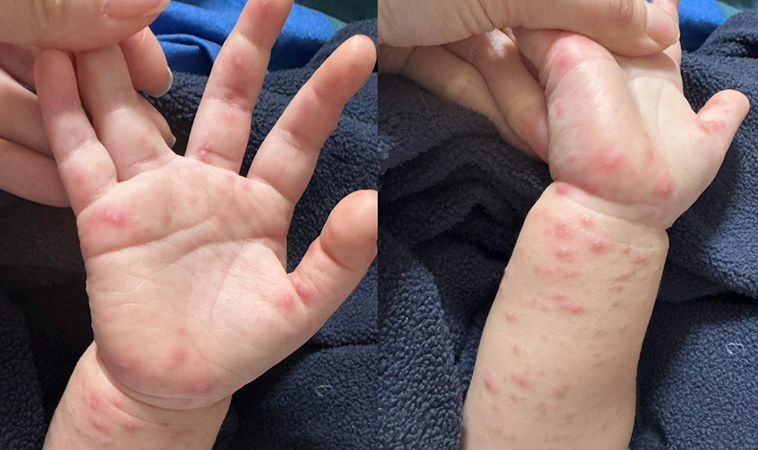 家長注意！高雄腸病毒爆群聚，隱匿病情最高罰 30 萬，「727 原則」一次懂