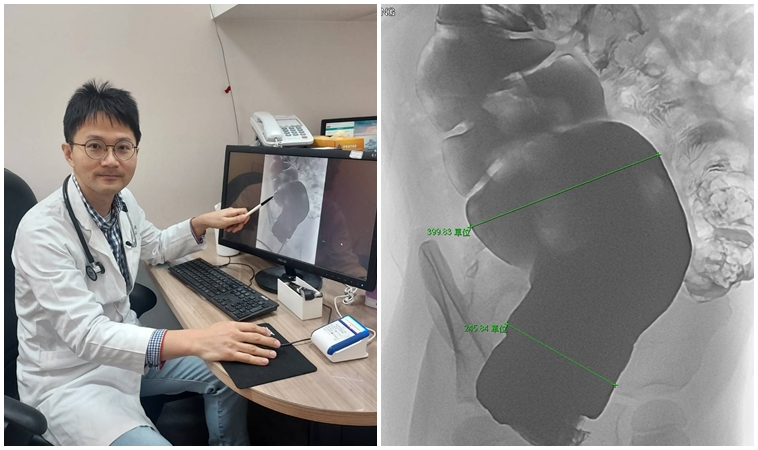 台南4歲女童長期便秘、害怕上廁所，媽媽不捨，竟是巨結腸症！嬰幼兒5症狀不能拖
